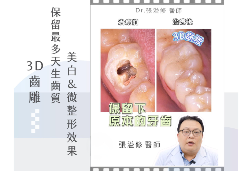 ❙ 3D齒雕-保留最多天生齒質、有美白＆微整形的效果❙   尊爵牙醫  張溢修醫師 案例分享