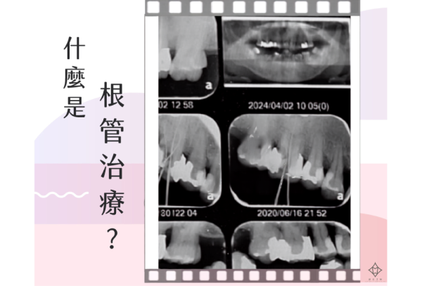 根管治療